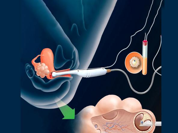 بازرگانی خرید غلاف چاک دار انتقال جنین