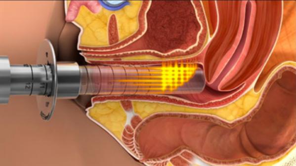 پخش کننده لینر واژن مصنوعی