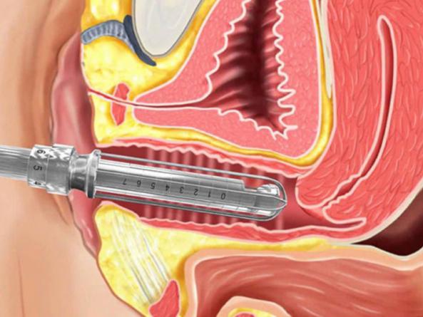 جنس لینر واژن مصنوعی از چیست؟