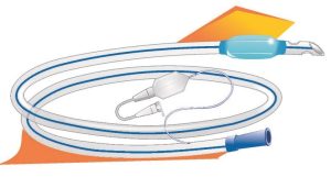 جنس منعطف کاتتر شستو شوی رحم